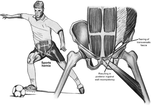 What is a sports hernia (or athletic pubalgia)? - International